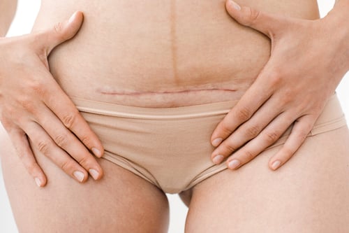 C-Section or Vaginal Birth: Pros, Cons, & the Best Option for You!